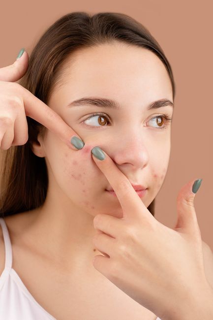 BiWeekly Acne Facial