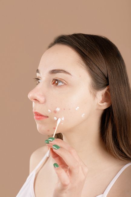 Acne Consultation With Treatment