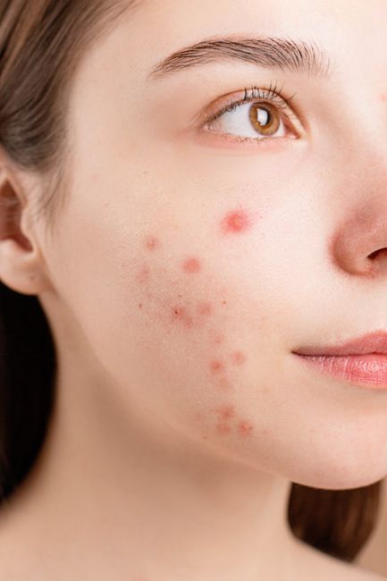 Microdermabrasion