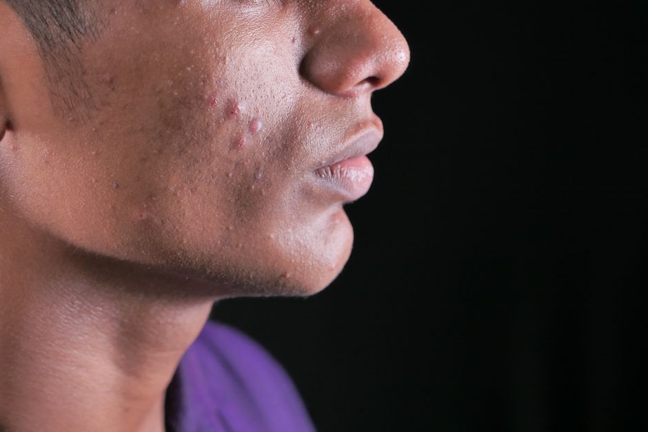 Back Facial