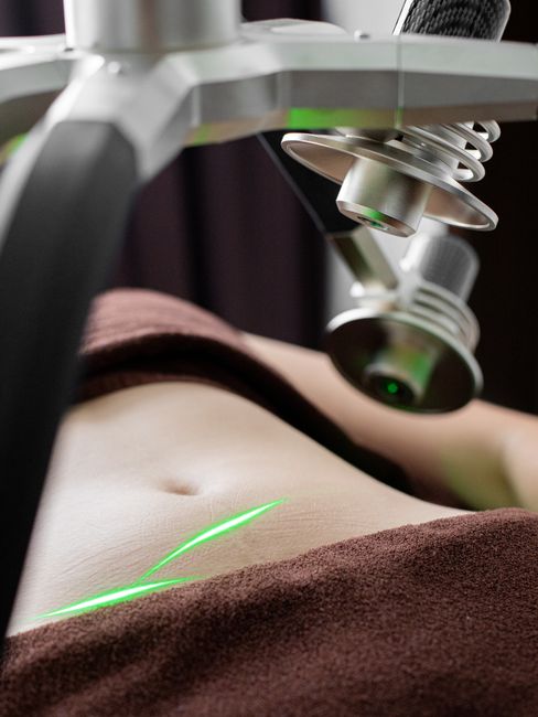 Radio Frequency Fat Reduction & Skin Tightening - Large Area