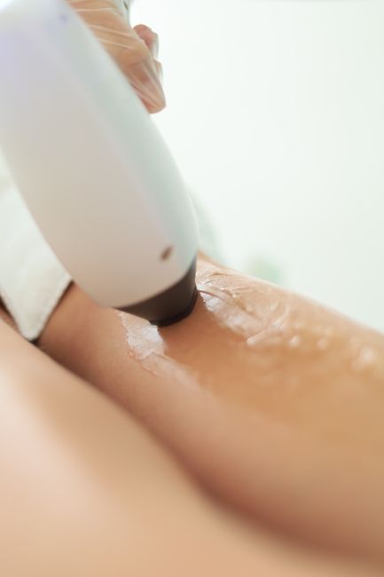 DPC Laser Hair Removal Men’s Beard Sculpt