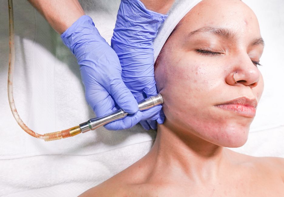 RF Microneedling Morpheus8 - Prime Around the Eyes service image