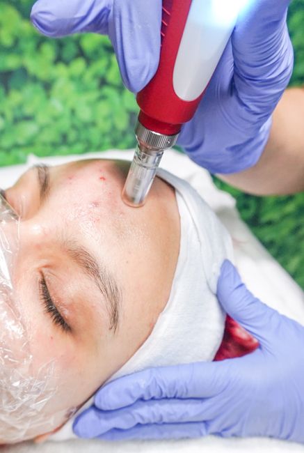 Microneedling with exosomes