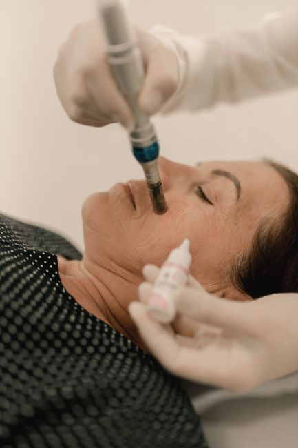 RF Microneedling Morpheus8 Body- Small Area service image