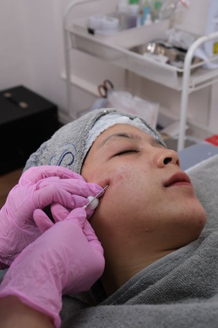 Acne Scar Repair