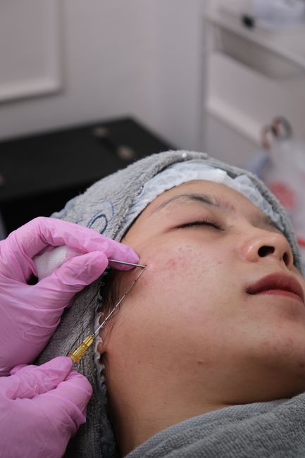 RF Microneedling Morpheus8 - Prime Around the Mouth service image
