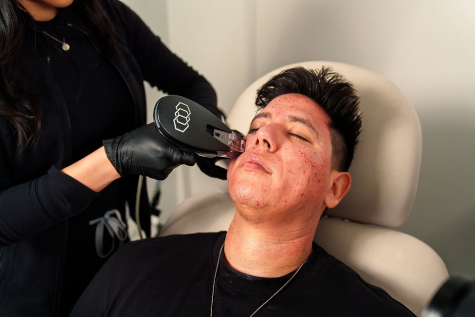 RF Microneedling Morpheus8 Body- Large Area service image